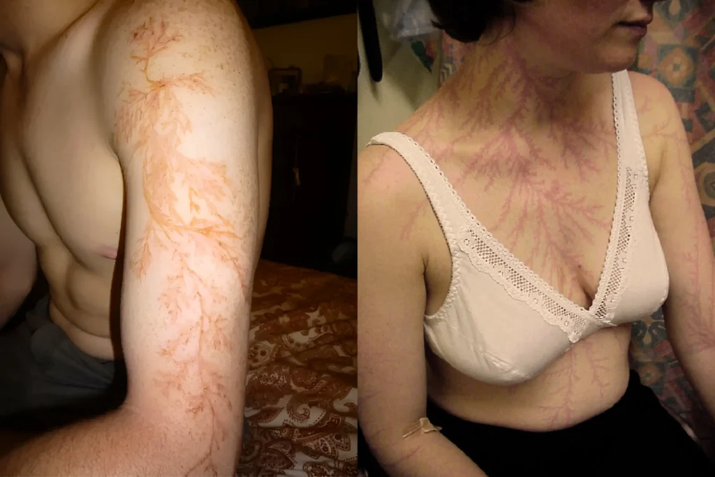 Lichtenberg figures after lighting strike